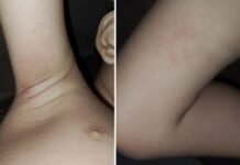 Petrolina (PE): Unidade Gabriel Barbosa no bairro José e Maria suspende atividades após casos de urticária em professores e alunos