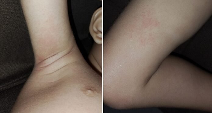 URTICARIA