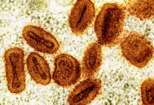 Bahia tem dois casos de Mpox confirmados em 2026