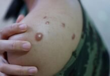 Sobe para 140 o número de casos confirmados de Mpox no Brasil em 2026