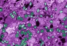 Mpox: 13 estados já confirmaram a doença; total de casos no país chega a 149