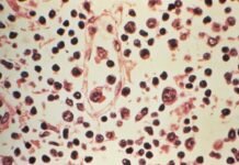 OMS alerta que hantavírus é altamente contagioso no início da doença