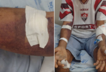 Homem é picado por cobra jaracaca em Casa Nova (BA) e é levado para o hospital