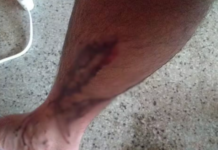 UFRPE é condenada a pagar R$ 10 mil a estudante atacado por cães dentro de campus em Serra Talhada (PE)